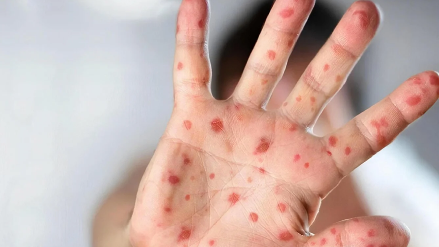 Температура, пухирці, біль у роті: на Київщині шириться небезпечна дитяча інфекція