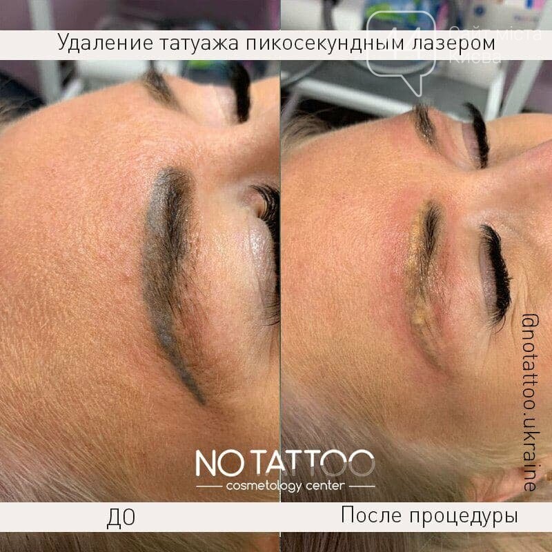 Лазерное удаление тату и татуажа наносекундным и пикосекундным лазерам ...