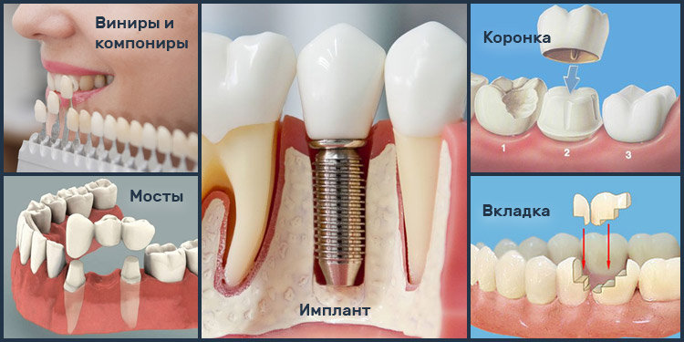 Протезирование , фото-1 Протезирование , фото-1