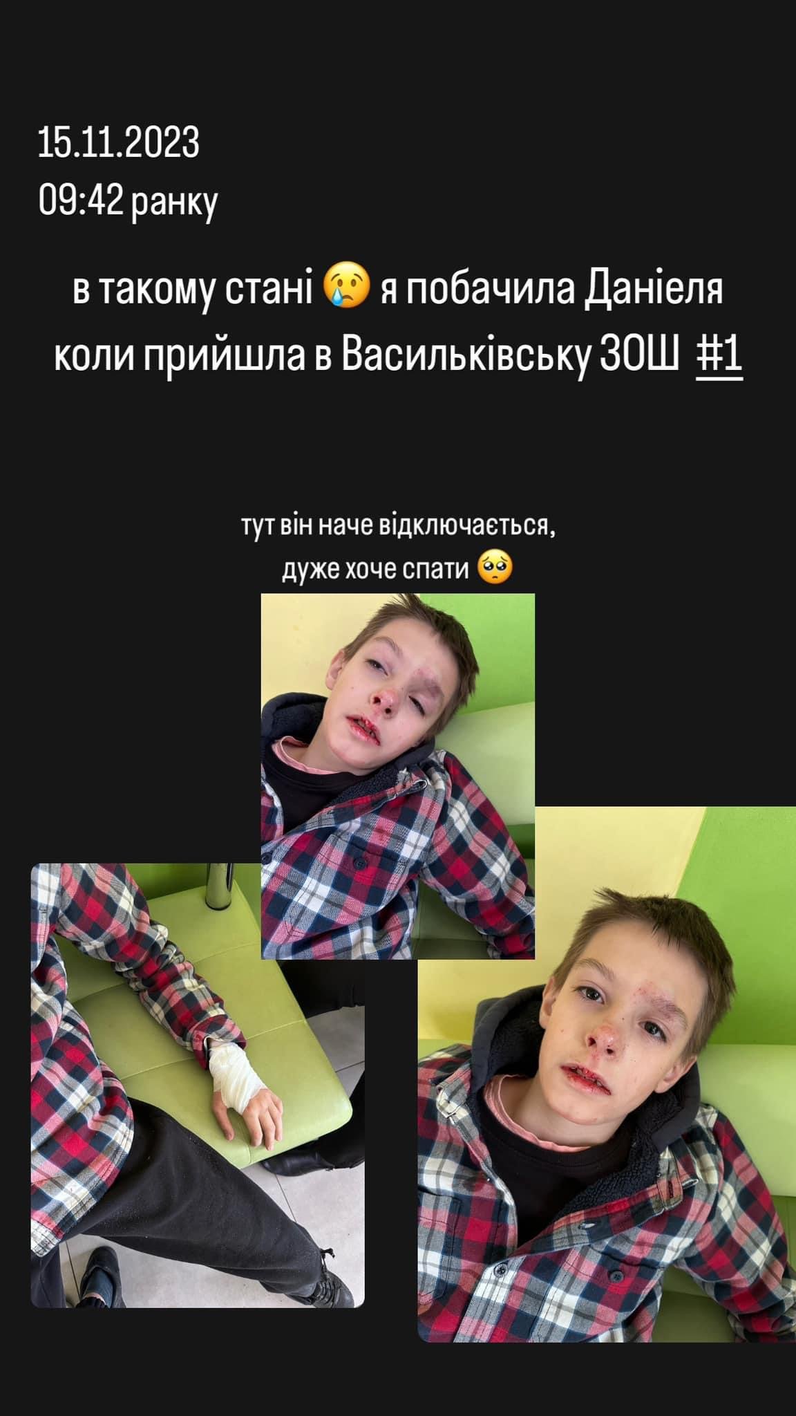 На Київщині дитину зіштовхнули у школі з висоти