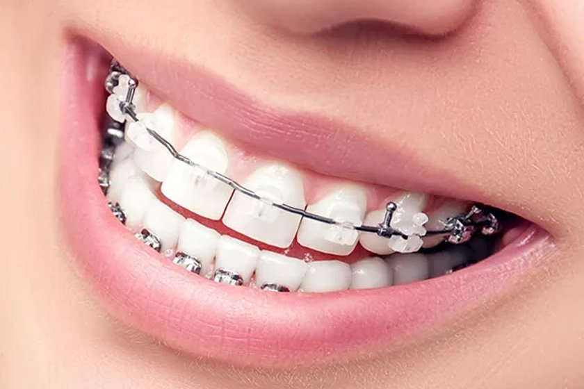 возможно ли отбелить зубы с брекет-системой