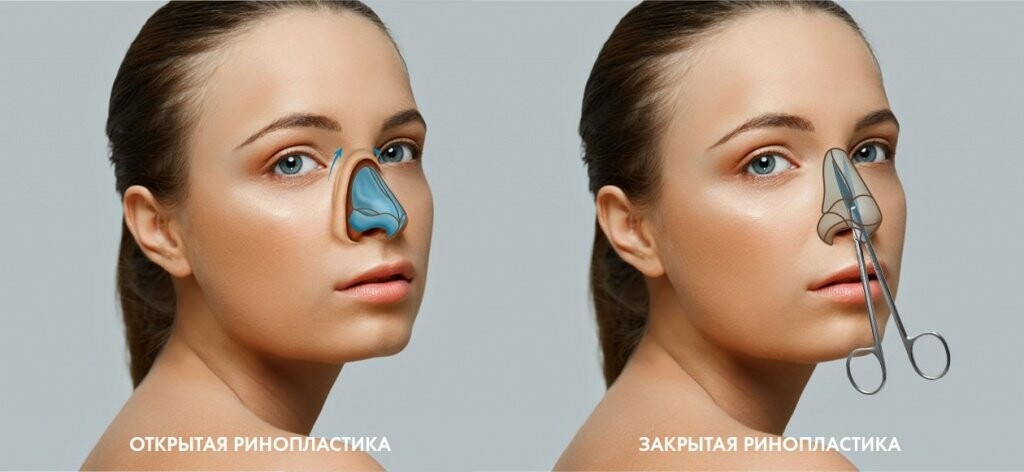 Ринопластика в Киеве: особенности и цена операции по пластике носа